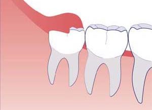 Wisdom teeth