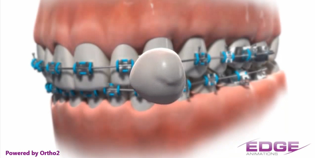 How to Put Wax on Your Braces?