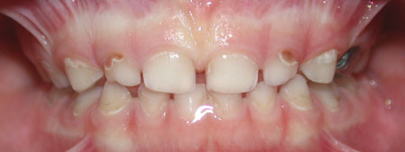 baby bottle tooth decay causes