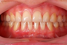 Receding gums: Are your teeth in peril?